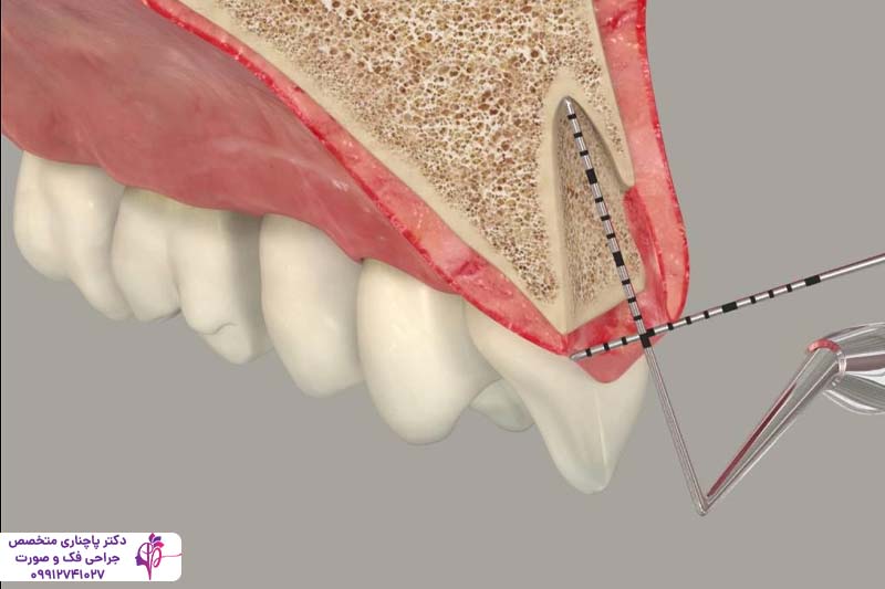 پیوند استخوان صورت