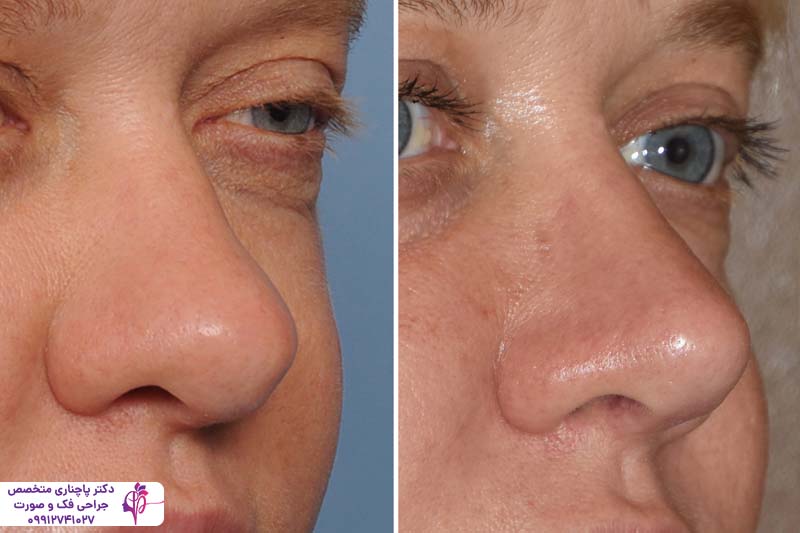 جراحی بینی گوشتی با غضروف ضعیف