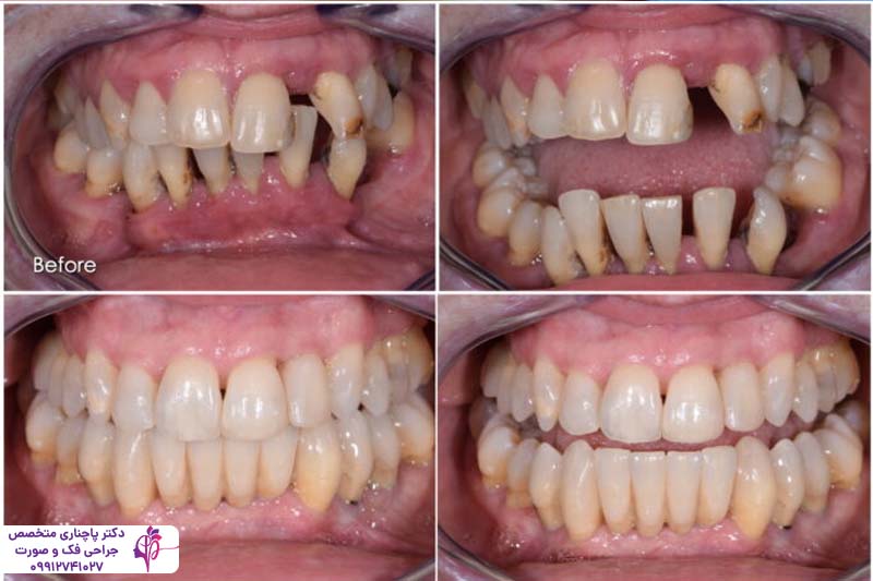 درمان بیماریهای لثه قبل از ایمپلنت