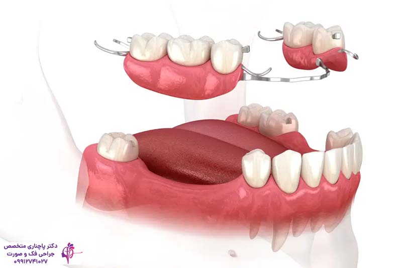 مقایسه فلیپر و ایمپلنت دندان