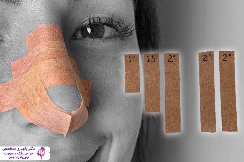 چسب زدن بینی بعد از عمل راینوپلاستی