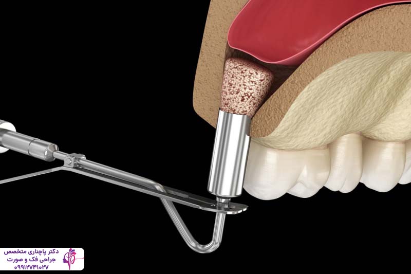 افتادن ایمپلنت داخل سینوس