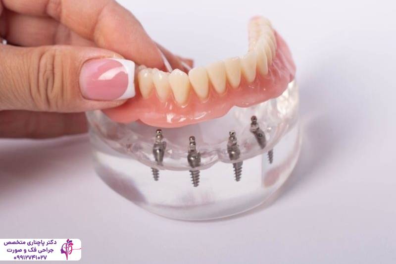 مقایسه پروتز و ایمپلنت دندان