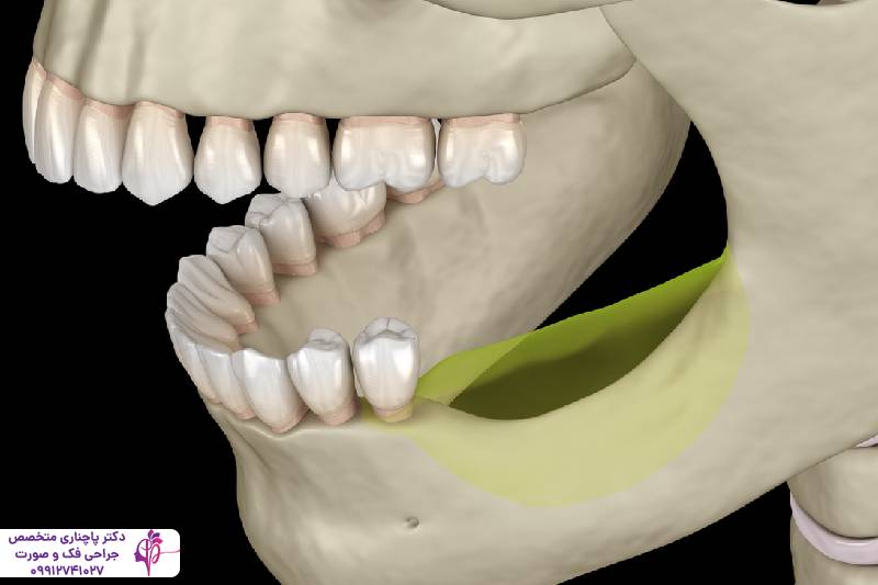 تحلیل استخوان فک