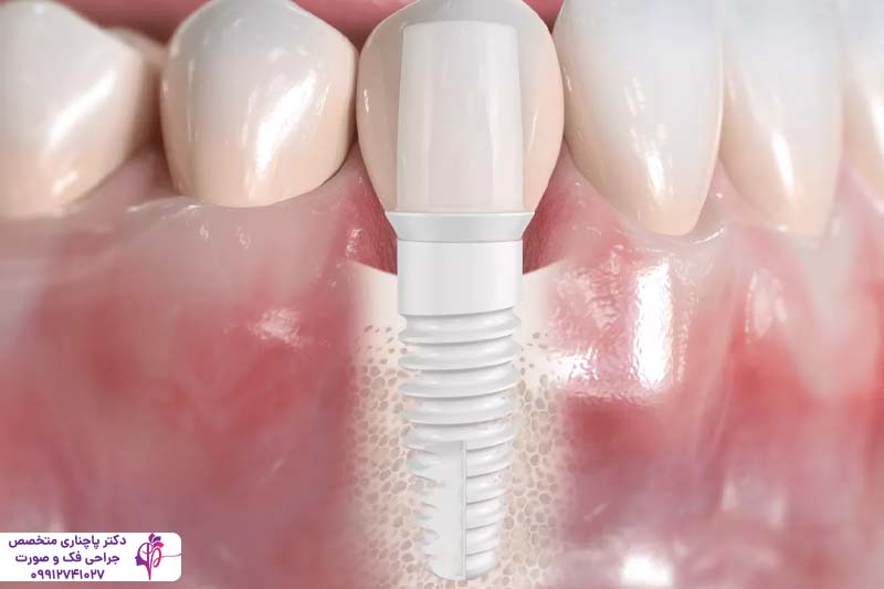 ایمپلنت سرامیکی یا پایه تیتانیومی