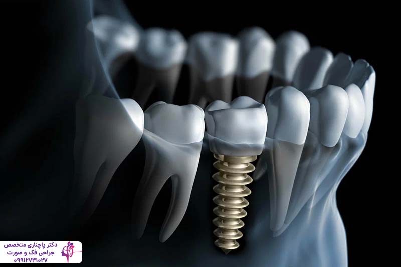 افتادن ایمپلنت داخل سینوس