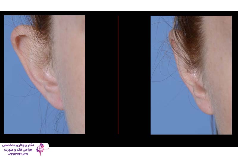 هزینه جراحی زیبایی گوش در تهران