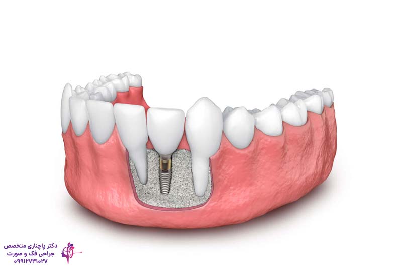 پیوند استخوان فک برای ایمپلنت