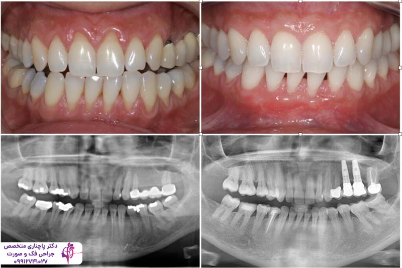 درمان بیماریهای لثه قبل از ایمپلنت