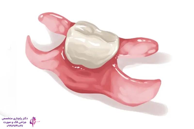 مقایسه فلیپر و ایمپلنت دندان