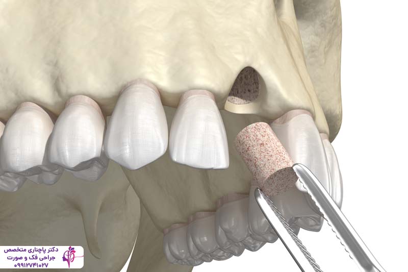 پیوند استخوان فک برای ایمپلنت
