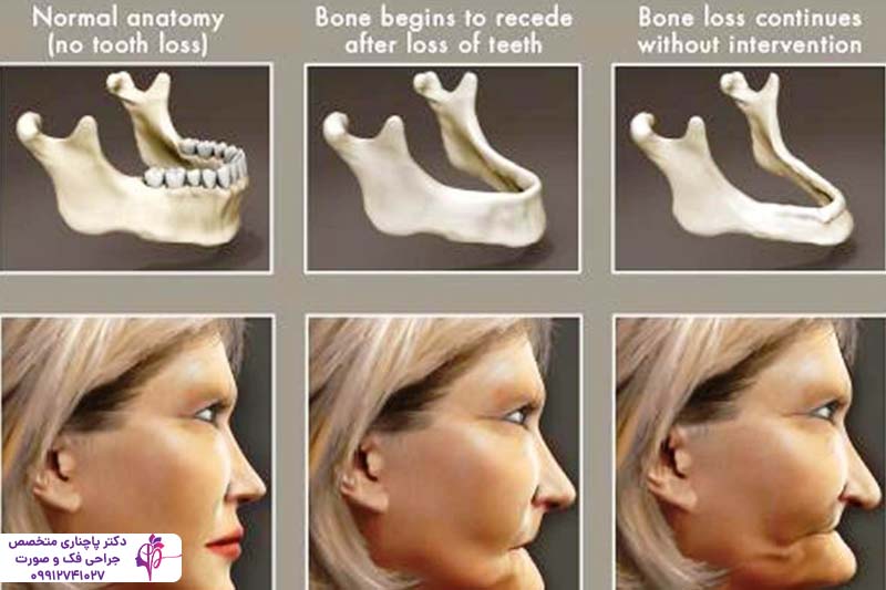 پیوند استخوان صورت