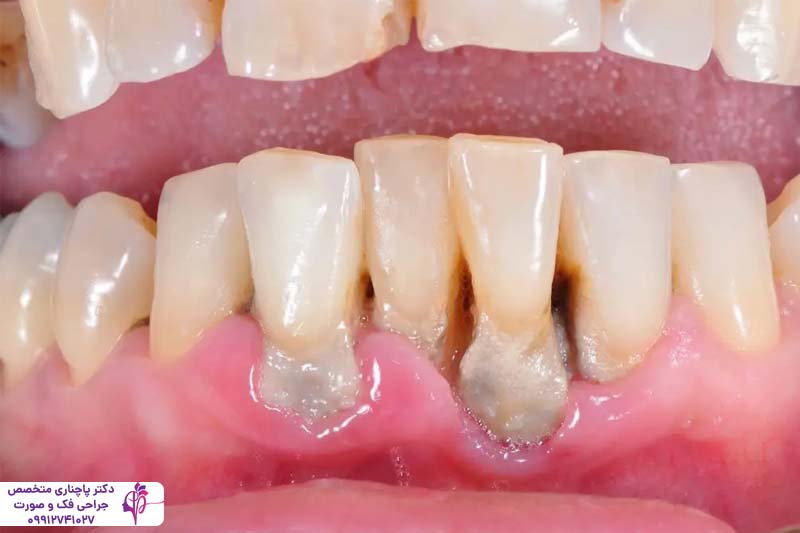 درمان بیماریهای لثه قبل از ایمپلنت