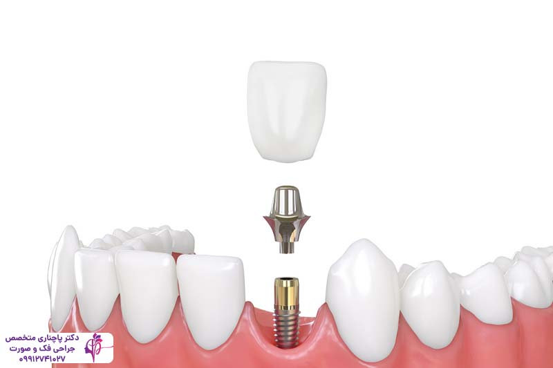 مقایسه فلیپر و ایمپلنت دندان