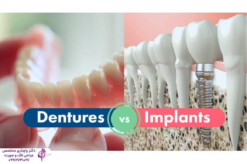 مقایسه پروتز و ایمپلنت دندان