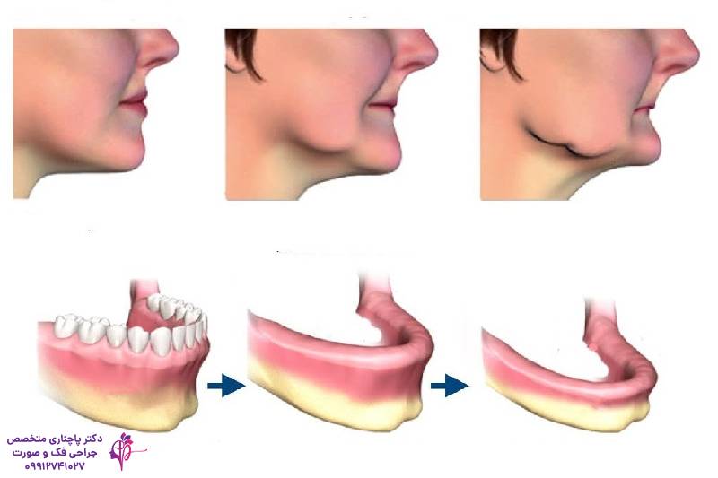 تحلیل استخوان فک