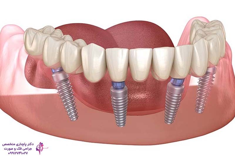 افتادن ایمپلنت داخل سینوس