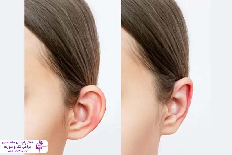 هزینه جراحی زیبایی گوش در تهران