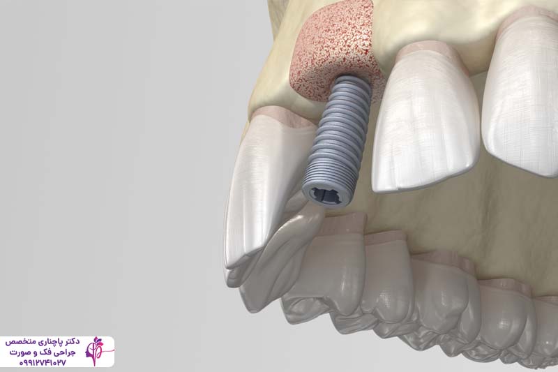 پیوند استخوان فک برای ایمپلنت