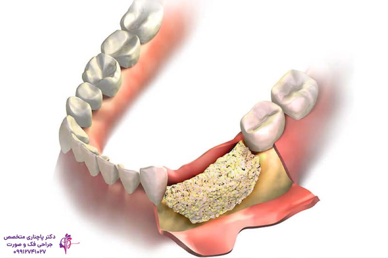 پیوند استخوان صورت