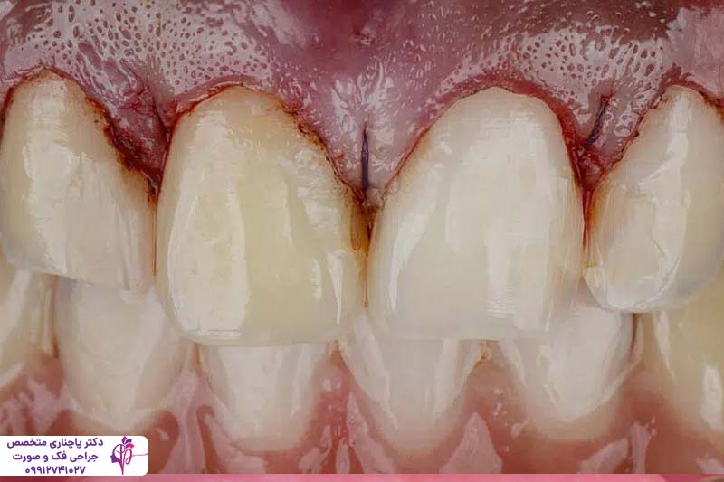 درمان بیماریهای لثه قبل از ایمپلنت