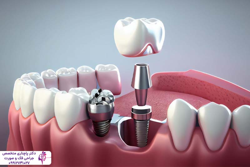 مقایسه فلیپر و ایمپلنت دندان