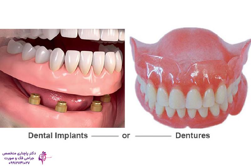 مقایسه پروتز و ایمپلنت دندان