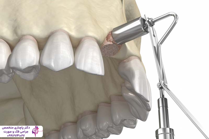 پیوند استخوان فک برای ایمپلنت