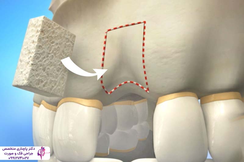 پیوند استخوان صورت