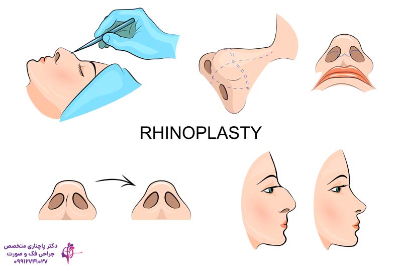 جراحی بینی گوشتی با غضروف ضعیف