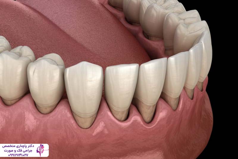 درمان بیماری‌های لثه قبل از ایمپلنت