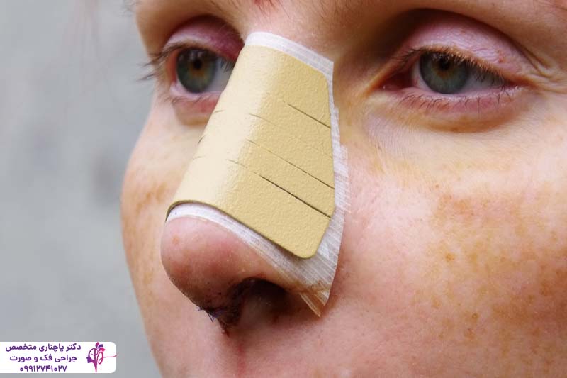 چسب زدن بینی بعد از عمل راینوپلاستی