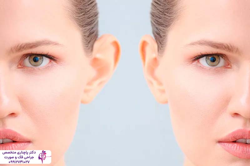 هزینه جراحی زیبایی گوش در تهران
