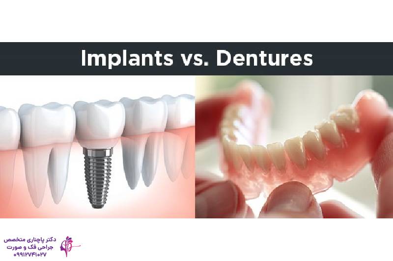 مقایسه پروتز و ایمپلنت دندان