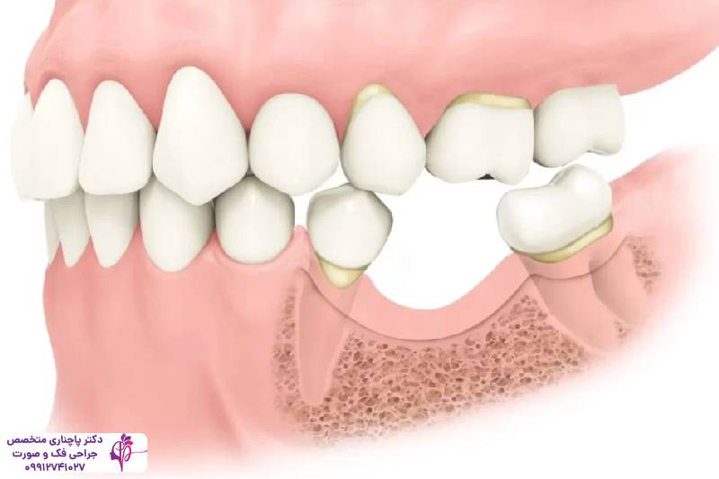 تحلیل استخوان فک
