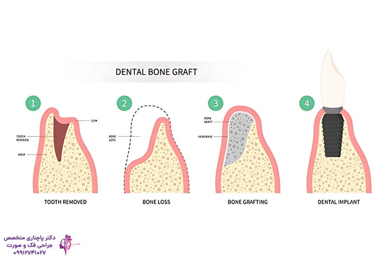 پیوند استخوان صورت