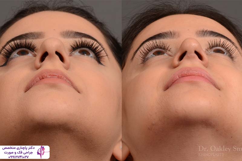 جراحی بینی گوشتی با غضروف ضعیف