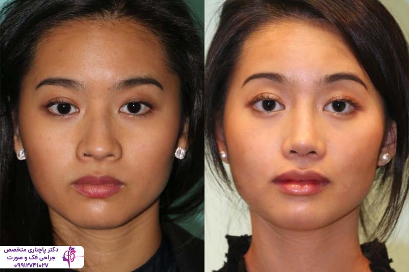 چسب زدن بینی بعد از عمل راینوپلاستی