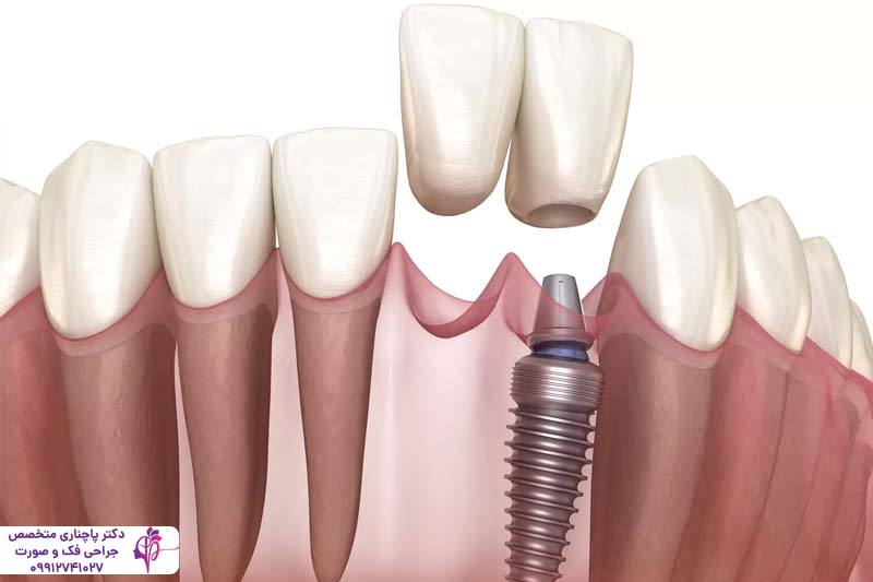 افتادن ایمپلنت داخل سینوس