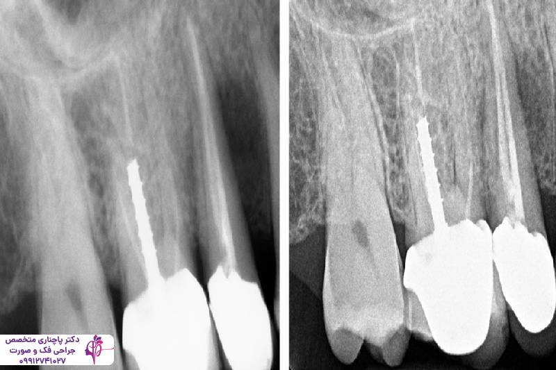 تحلیل استخوان فک