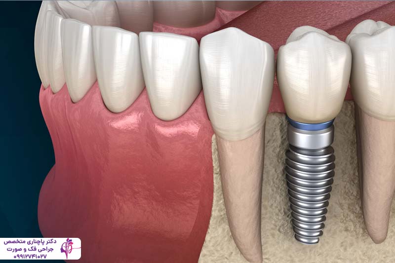 مقایسه فلیپر و ایمپلنت دندان