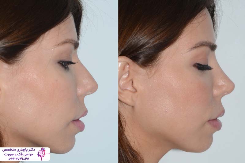 رینوپلاستی نیمه فانتزی