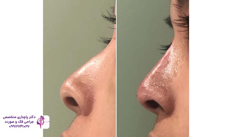 رینوپلاستی بدون جراحی