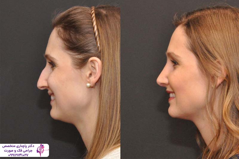 رینوپلاستی نیمه فانتزی