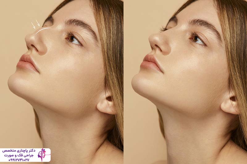 رینوپلاستی به روش پرزرویشن