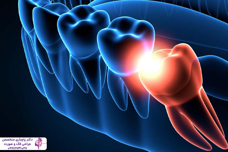 جراحی دندان عقل