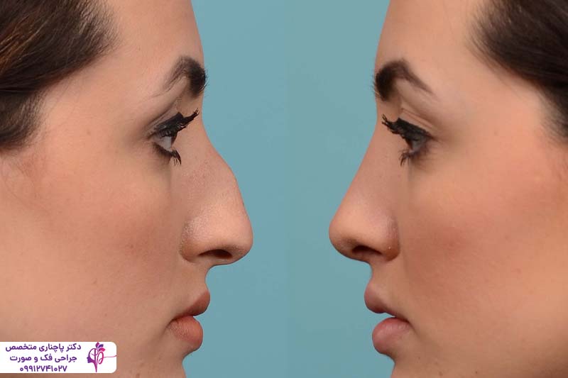 رینوپلاستی نیمه فانتزی