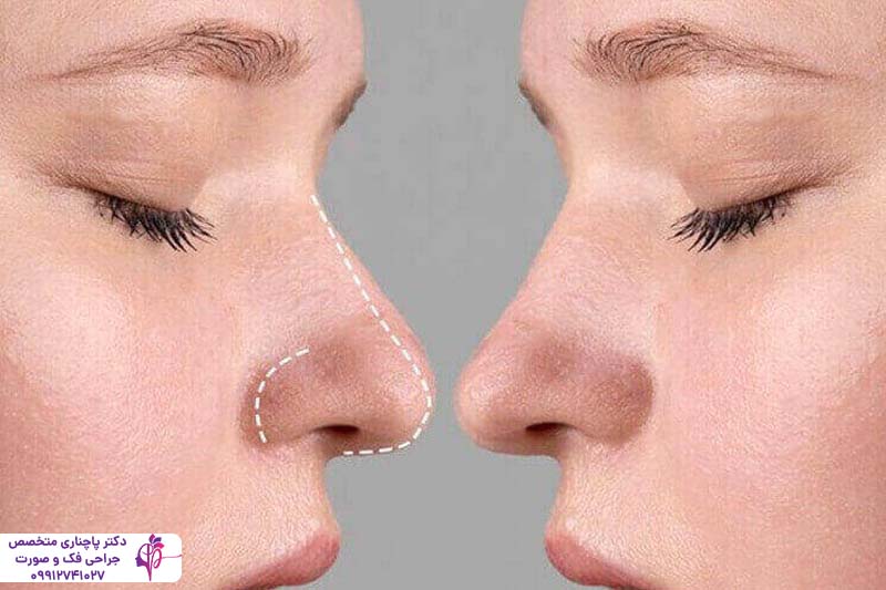 رینوپلاستی به روش پرزرویشن