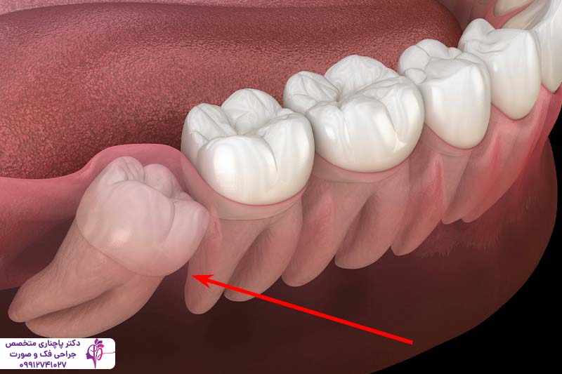 جراحی دندان عقل
