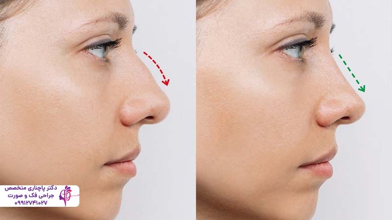 رینوپلاستی بدون جراحی